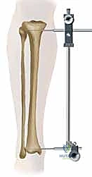 تشريح عظم الساق والكسور الشائعة