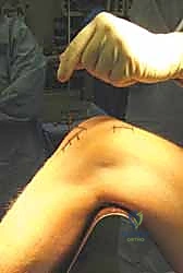 تطور علاج كسور الساق عبر الزمن