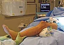 أعراض كسر الساق الظنبوب