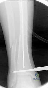 الإصابات الرياضية وكسور العظام