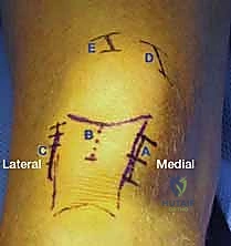 التخطيط الجراحي قبل العملية
