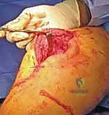 التورم والكدمات المصاحبة للكسر