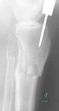 حوادث السير كسبب رئيسي لكسور الساق