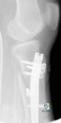 صورة طبية: التسمير النخاعي لكسور عظم الساق (الظنبوب): دليل شامل للمرضى مع الأستاذ الدكتور محمد هطيف