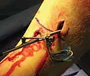 صورة طبية: التسمير النخاعي لكسور عظم الساق (الظنبوب): دليل شامل للمرضى مع الأستاذ الدكتور محمد هطيف