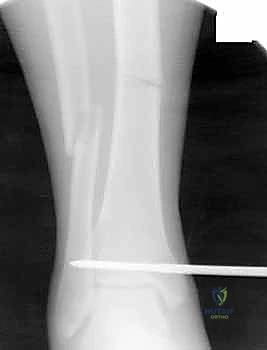 صورة توضيحية لـ التسمير النخاعي لكسور عظم الساق (الظنبوب): دليل شامل للمرضى مع الأستاذ الدكتور محمد هطيف