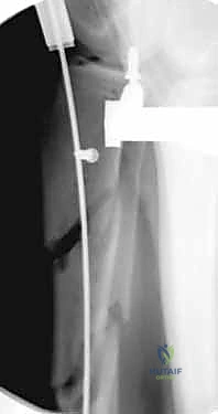 استخدام جهاز الأشعة C-arm أثناء الجراحة