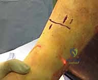 استخدام العكازات في المرحلة الأولى