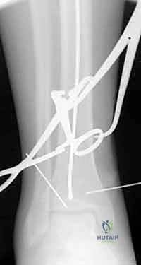 صورة توضيحية لـ التسمير النخاعي لكسور عظم الساق (الظنبوب): دليل شامل للمرضى مع الأستاذ الدكتور محمد هطيف