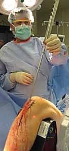 ميكانيكية التسمير النخاعي