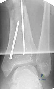 صورة طبية: التسمير النخاعي لكسور عظم الساق (الظنبوب): دليل شامل للمرضى مع الأستاذ الدكتور محمد هطيف