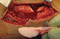 التيتانيوم الطبي المستخدم في المسامير