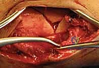 التسمير النخاعي لكسور عظم الساق (الظنبوب): دليل شامل للمرضى مع الأستاذ الدكتور محمد هطيف