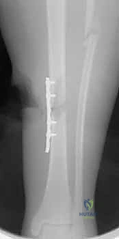 تمارين تقوية عضلات الساق والفخذ