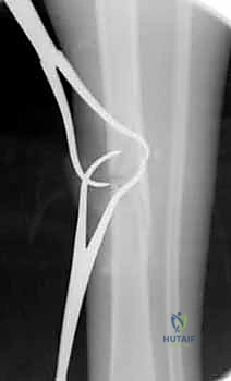 صورة طبية: التسمير النخاعي لكسور عظم الساق (الظنبوب): دليل شامل للمرضى مع الأستاذ الدكتور محمد هطيف
