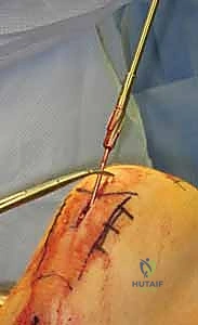 نتائج التسمير النخاعي الممتازة