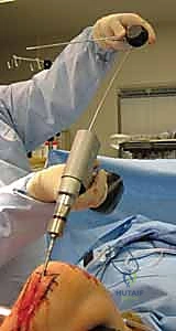 صورة أشعة بعد التثبيت الناجح