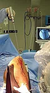 صورة طبية: التسمير النخاعي لكسور عظم الساق (الظنبوب): دليل شامل للمرضى مع الأستاذ الدكتور محمد هطيف