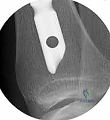 صورة طبية: التسمير النخاعي لكسور عظم الساق (الظنبوب): دليل شامل للمرضى مع الأستاذ الدكتور محمد هطيف