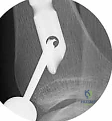 التثبيت الداخلي مقابل الخارجي