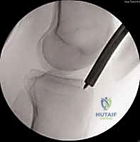 صورة توضيحية لـ التسمير النخاعي لكسور عظم الساق (الظنبوب): دليل شامل للمرضى مع الأستاذ الدكتور محمد هطيف