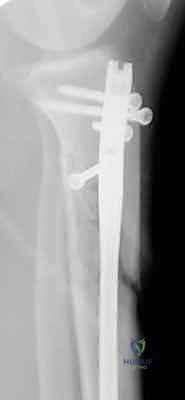 صورة طبية: التسمير النخاعي لكسور عظم الساق (الظنبوب): دليل شامل للمرضى مع الأستاذ الدكتور محمد هطيف