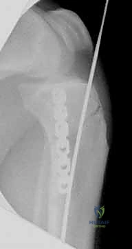 إدخال المسمار النخاعي المصنوع من التيتانيوم