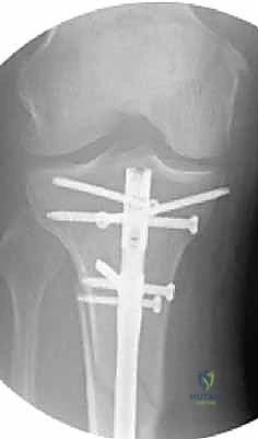 صورة توضيحية لـ التسمير النخاعي لكسور عظم الساق (الظنبوب): دليل شامل للمرضى مع الأستاذ الدكتور محمد هطيف