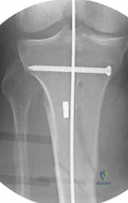 صورة توضيحية لـ التسمير النخاعي لكسور عظم الساق (الظنبوب): دليل شامل للمرضى مع الأستاذ الدكتور محمد هطيف