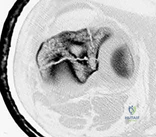 صورة توضيحية للتثبيت التشابكي