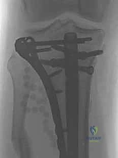 صورة طبية: التسمير النخاعي لكسور عظم الساق (الظنبوب): دليل شامل للمرضى مع الأستاذ الدكتور محمد هطيف