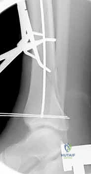 صورة توضيحية لـ التسمير النخاعي لكسور عظم الساق (الظنبوب): دليل شامل للمرضى مع الأستاذ الدكتور محمد هطيف