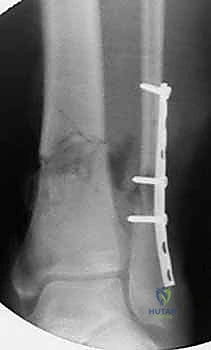 صورة طبية: التسمير النخاعي لكسور عظم الساق (الظنبوب): دليل شامل للمرضى مع الأستاذ الدكتور محمد هطيف