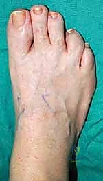 الأشعة السينية تظهر قصر مشط القدم الأول بوضوح