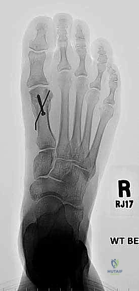 توضح الأعراض وتشوهات الأصابع المرافقة