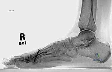 الفحص السريري الدقيق للقدم والكاحل