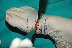 تحرير الأنسجة الرخوة المحيطة بالمفصل