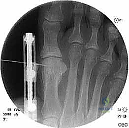 وضع الطعم العظمي لملء الفراغ وإطالة العظم