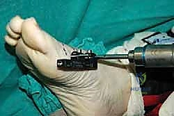 صورة توضيحية لـ إطالة مشط القدم الأول لعلاج إبهام القدم الأروح المرتجع: حل نهائي لآلام القدم المزمنة في صنعاء