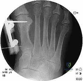 إطالة مشط القدم الأول لعلاج إبهام القدم الأروح المرتجع: حل نهائي لآلام القدم المزمنة في صنعاء