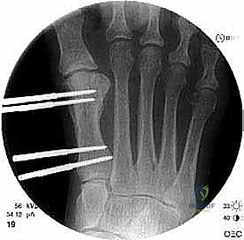 صورة توضيحية لـ إطالة مشط القدم الأول لعلاج إبهام القدم الأروح المرتجع: حل نهائي لآلام القدم المزمنة في صنعاء