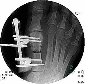 استخدام الضبانات الطبية كعلاج تحفظي