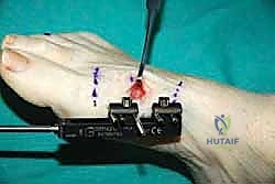 صورة توضيحية لـ إطالة مشط القدم الأول لعلاج إبهام القدم الأروح المرتجع: حل نهائي لآلام القدم المزمنة في صنعاء