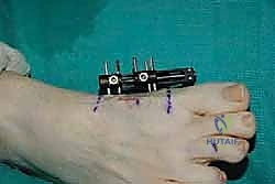 صورة توضيحية لـ إطالة مشط القدم الأول لعلاج إبهام القدم الأروح المرتجع: حل نهائي لآلام القدم المزمنة في صنعاء