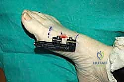 صورة طبية: إطالة مشط القدم الأول لعلاج إبهام القدم الأروح المرتجع: حل نهائي لآلام القدم المزمنة في صنعاء