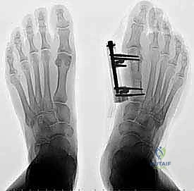 First Metatarsal Lengthening for Revision Hallux Valgus: An Intraoperative Masterclass