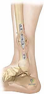 صورة توضيحية لـ كسور قصبة الساق لدى الأطفال: دليل شامل للآباء والعلاج المتطور مع الأستاذ الدكتور محمد هطيف في صنعاء