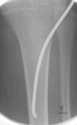 صورة توضيحية لـ كسور قصبة الساق لدى الأطفال: دليل شامل للآباء والعلاج المتطور مع الأستاذ الدكتور محمد هطيف في صنعاء