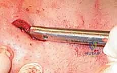 أنواع كسور قصبة الساق المختلفة