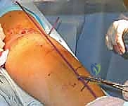 العلاج التحفظي والجبس